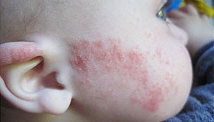 Фото симптомы аллергии на сладкое у ребенка.