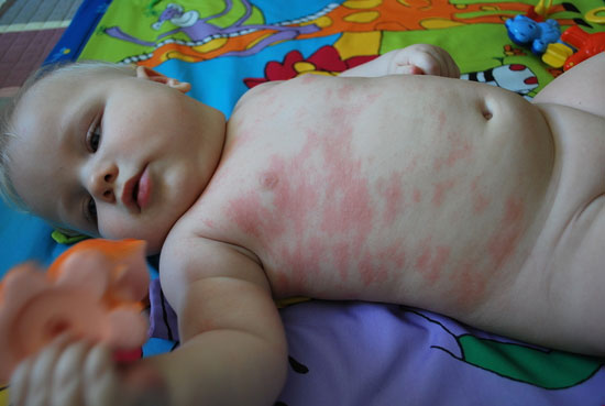 Фото аллергии на чай у ребенка