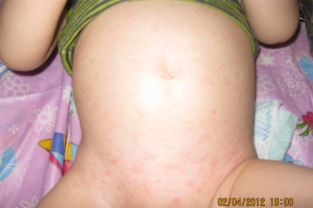 Фото аллергии на индейку у ребенка