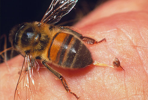 аллергическая реакция на укусы пчел