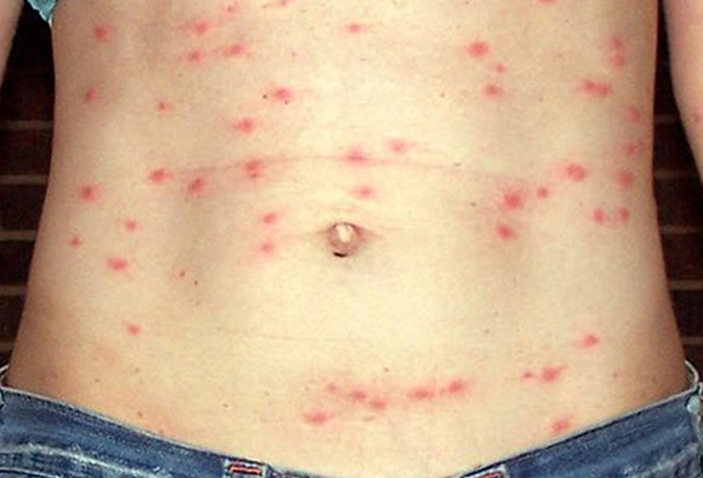 проявление аллергической реакции на укусы комаров