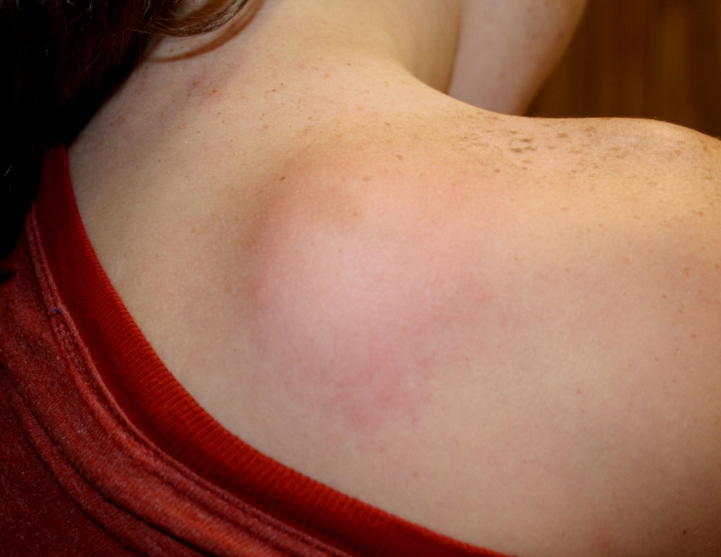 аллергический спиной фото