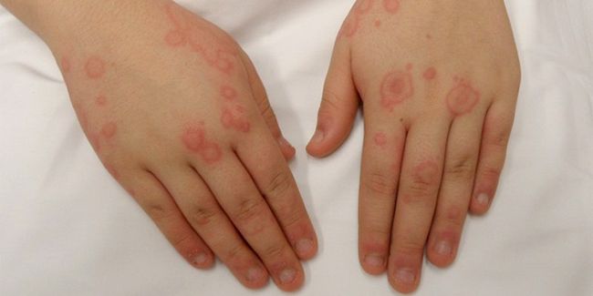Лечение аллергии от холода народными средствами с каждым годом набирает все больше популярности