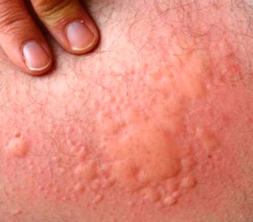 Клинические признаки аллергии на пыльцу