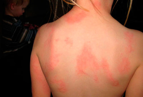 Аллергия на мяту – симптомы и признаки