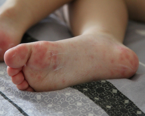 Как можно распознать, что на стопах аллергия?