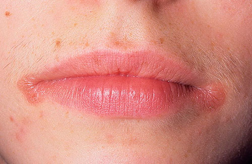 Виды аллергии на губах