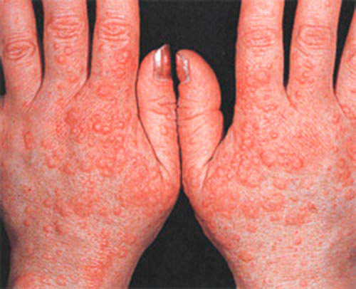 Признаки аллергии на кистях рук