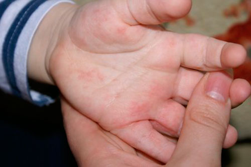 Аллергия на ладонях: симптомы