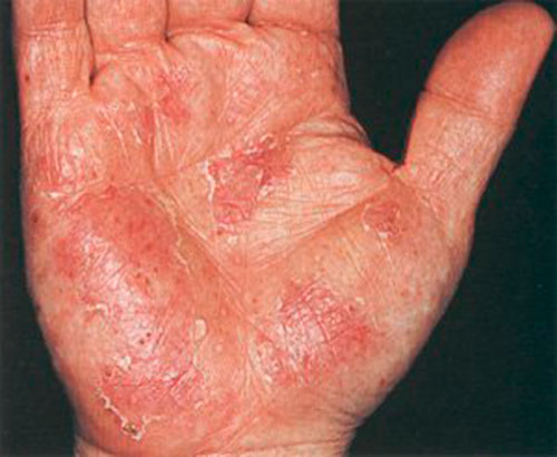 Аллергия на ладонях: причины