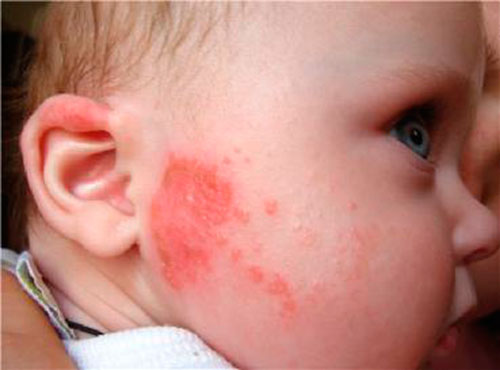 Аллергия на лице ребенка