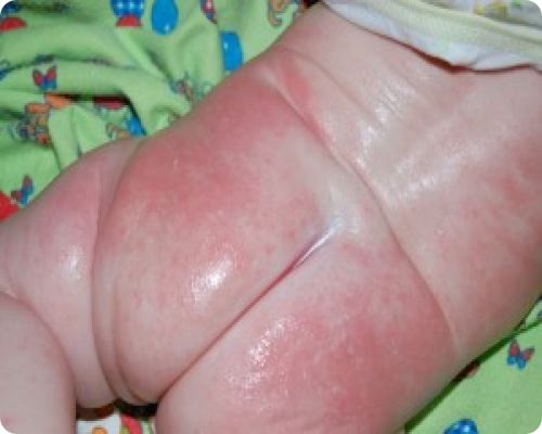 Аллергическая сыпь на попе у ребенка