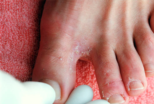 Проявление аллергии на ногах