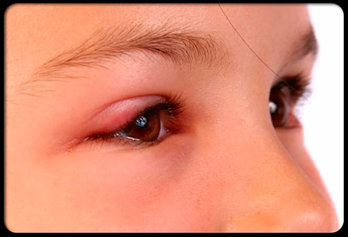 Аллергия глаз: симптомы