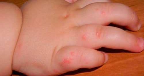 Аллергия на руках ребенка