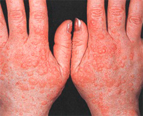 Виды и особенности аллергии на руках