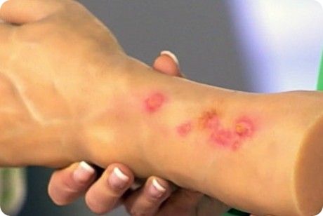 Аллергия на муку: симптомы