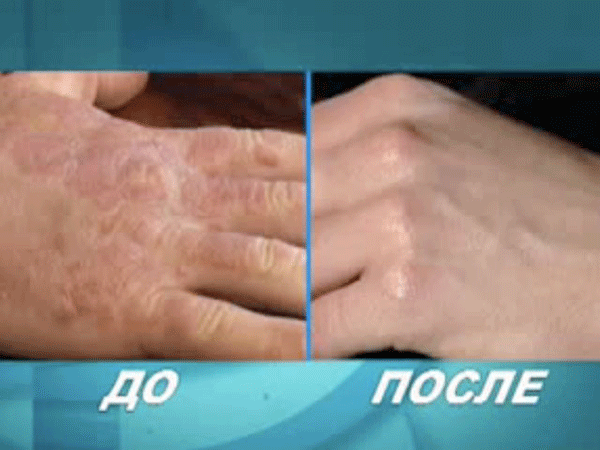 Способы лечения контактного аллергического дерматита