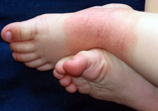 Токсико-аллергический дерматит у детей