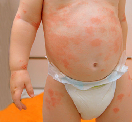 Аллергия на теле у ребенка