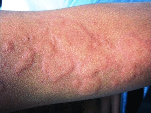 Признаки аллергии на теле