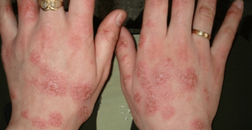 Симптомы аллергических проявлений