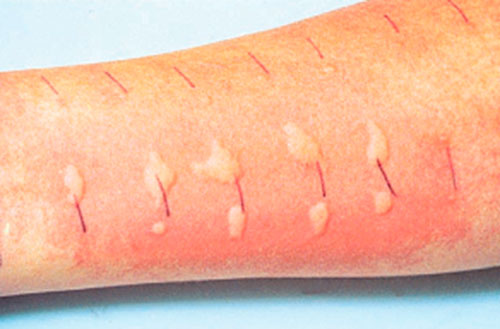 кожные пробы на аллергию при пузырьках в паху у мужчин