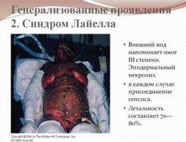Синдром Лайелла