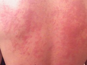 Что делать, если во время аллергического приступа возникла припухлость кожи