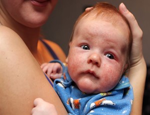 Аллергический дерматит у новорожденного.