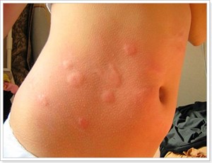 Аллергия на укус насекомого: опухлость кожи.