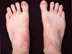 Аллергическая экзема на ногах