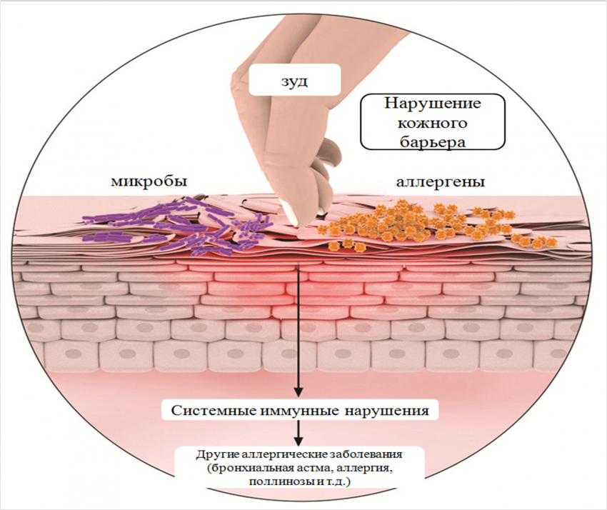 механизм развития экземы