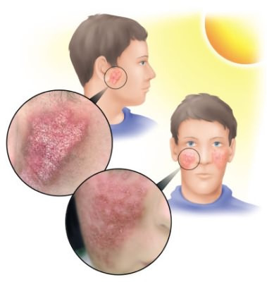 Влияние солнечных лучей на кожу человека.
