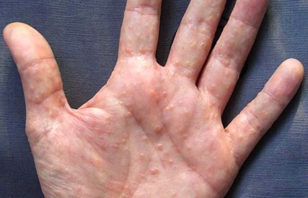 Дигидротическая экзема кистей рук