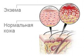 Гнойная экзема: причины, симптомы, лечение