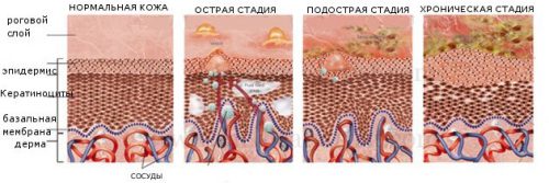 Стадии экземы