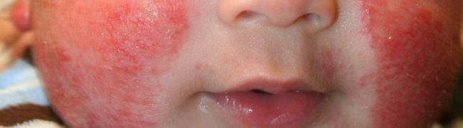Аллергия на холод у ребенка – это заболевание, которое не на шутку заставляет волноваться родителей