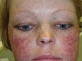 Аллергия на холод на лице
