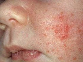 Аллергия на холод у ребенка
