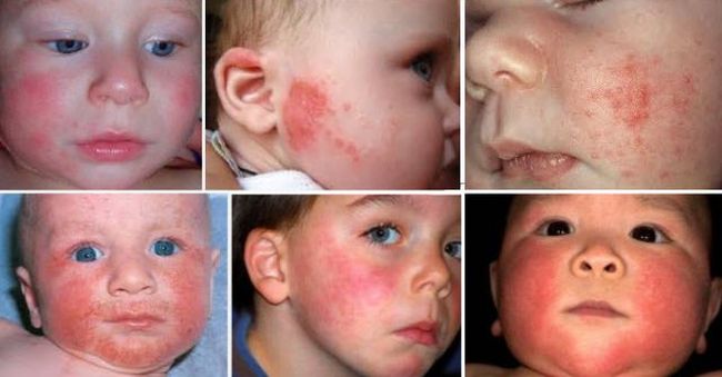 Холодовую аллергию у малышей нередко называют псевдоаллергией. Обусловлено такое название практическим отсутствием раздражителя-аллергена как такового