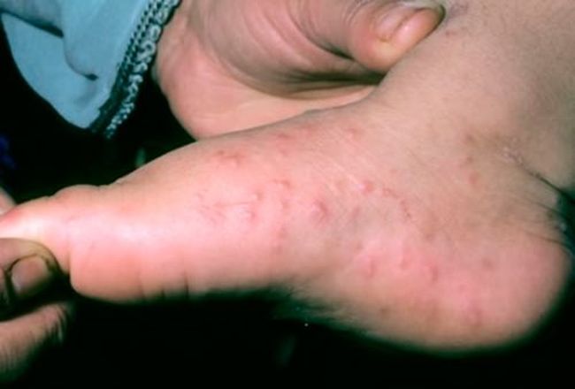 Аллергия на холод на ногах возникает из-за воздействия низких температур