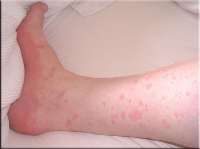 Холодовая аллергия на ногах временами встречается у людей, которые серьезно относятся к своему здоровью