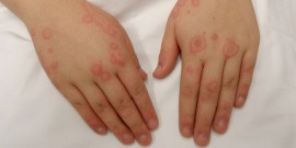 Аллергия на холод на руках: характерные симптомы и как лечить заболевание