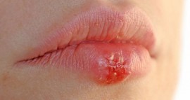 Экзема на губах: что это такое, каковы симптомы и причины, особенности терапии