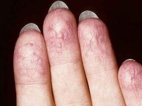 первые признаки экземы на пальцах рук - трещины, шелушение, зуд