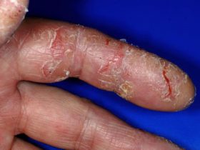 Экзема на пальцах рук визуально ни чем не отличается от других видов дерматоза