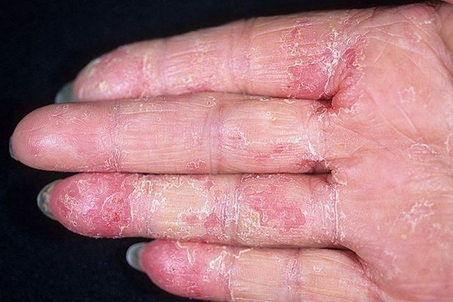 Проявление экземы (дерматоза) на пальцах руки
