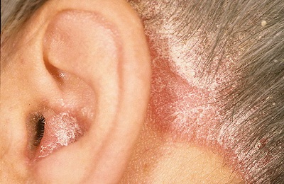Экзема уха может возникнуть на нервной почве