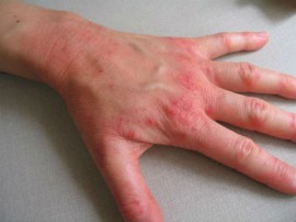 Хроническая экзема на руках, кистях и стопах — как лечить болезнь?